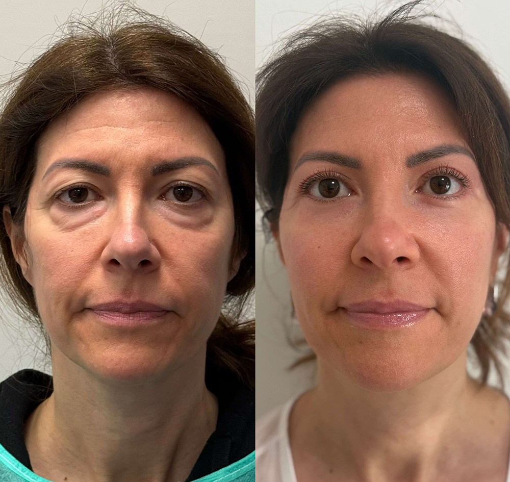 Upper and lower bleph with lipofilling